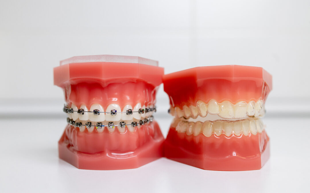 The image shows two models of teeth. One has braces and the other has Invisalign. The image represents whether braces or Invisalign is better for you.