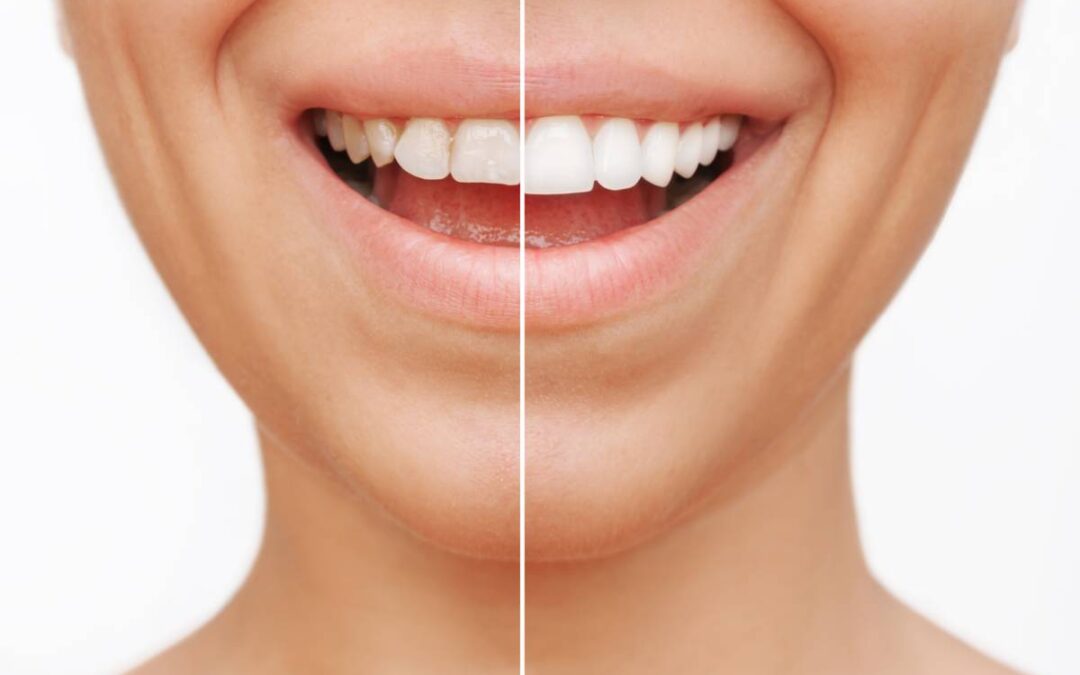 Featured image for Do Dental Veneers Stain?