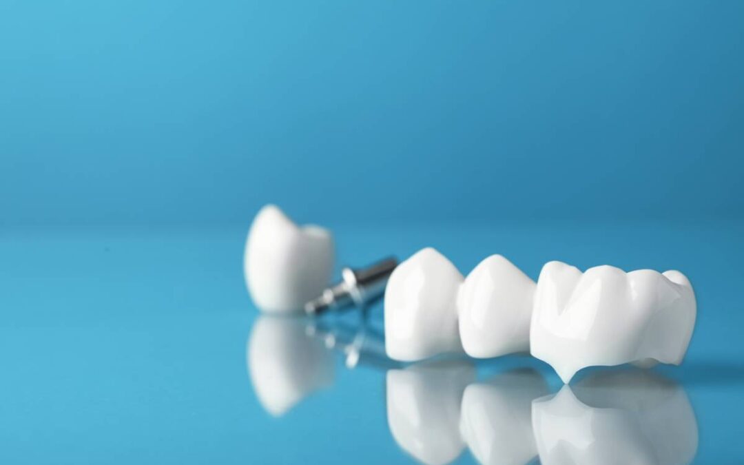 What Type of Dental Bridge Is Best for You?